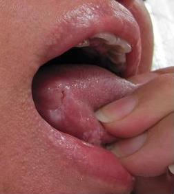 Tongue Cancer Pictures, Symptoms, Treatment, Prognosis ...